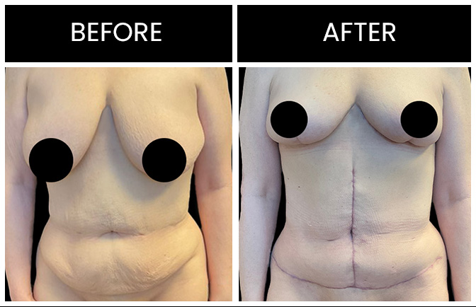 Fleur De Lis Tummy Tuck Results Atlanta