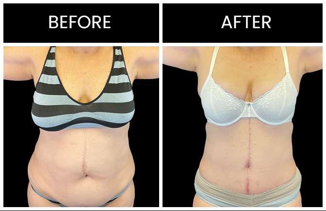 Fleur De Lis Tummy Tuck Atlanta