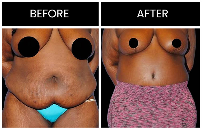 Body Lift Results Atlanta