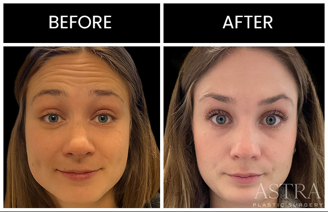 Botox Results Atlanta