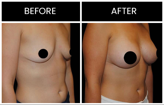 Breast Augmentation Results Atlanta