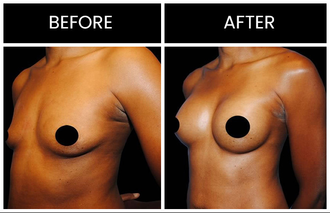Atlanta Breast Augmentation Results