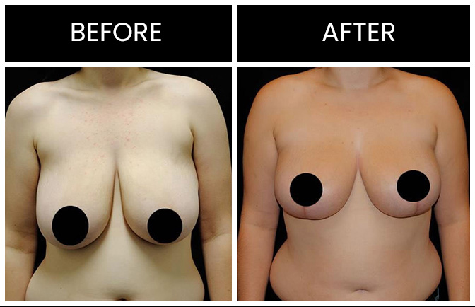 Breast Lift Results Atlanta