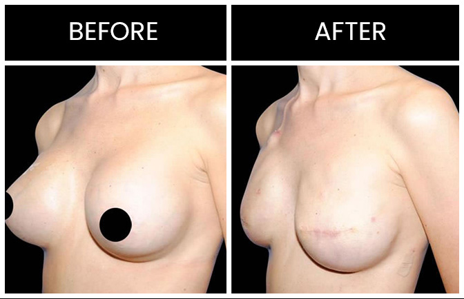 Breast Reconstruction Results Atlanta