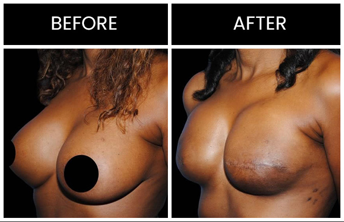 Atlanta Breast Reconstruction Results