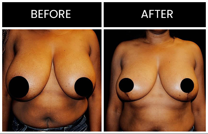 Atlanta Breast Reduction Results