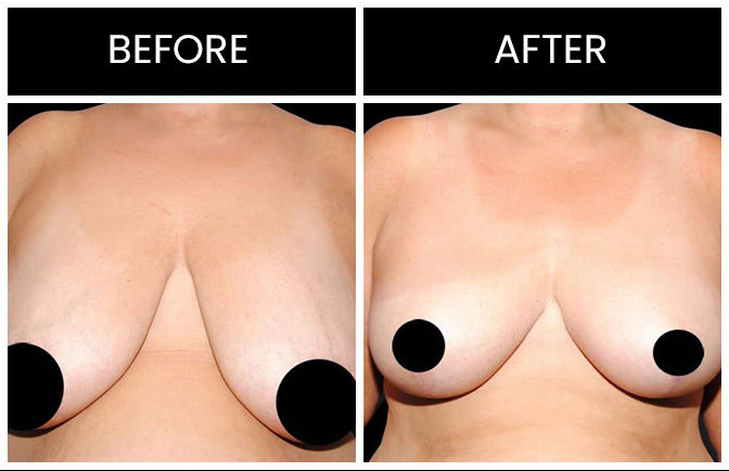 Breast Reduction Results Atlanta