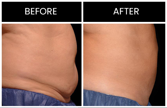 CoolSculpting Results Atlanta