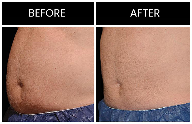 Atlanta CoolSculpting Results