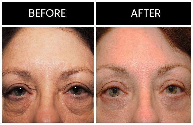 Atlanta Eyelid Surgery Results