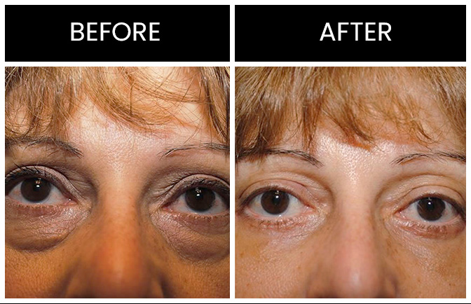 Eyelid Surgery Results Atlanta