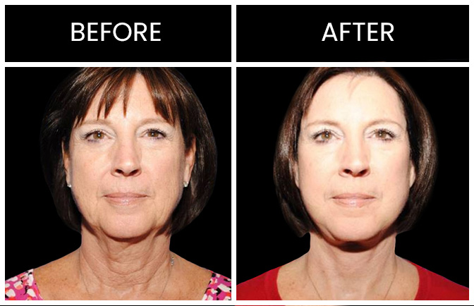 Facelift Results Atlanta