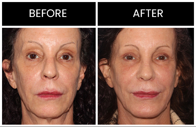 Atlanta Facelift Results