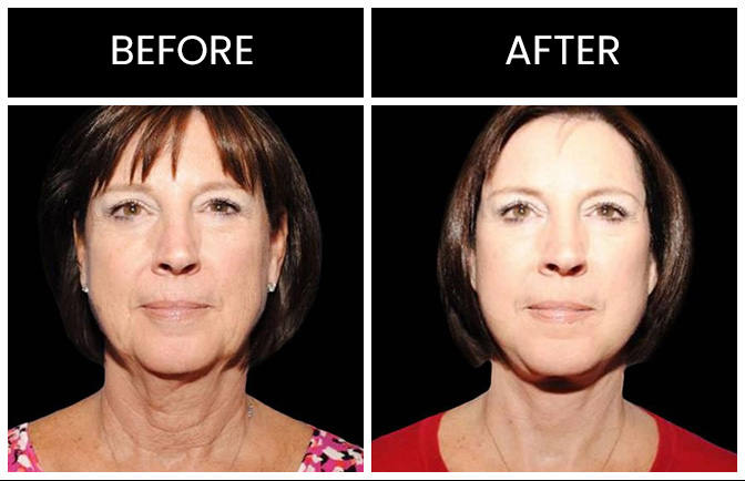 Atlanta Facelift Results