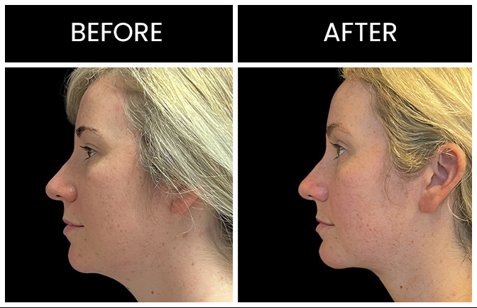 Atlanta Facial Liposuction Results
