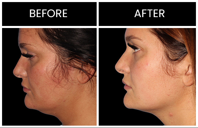Facial Liposuction Results Atlanta
