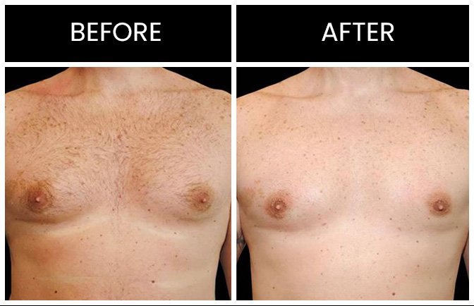 Atlanta Gynecomastia Results