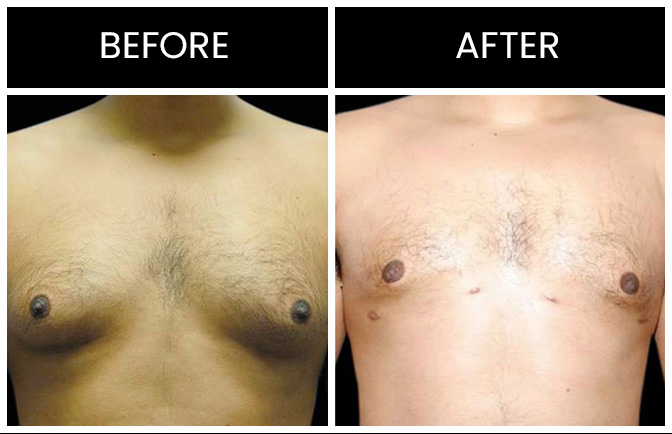 Gynecomastia Results Atlanta