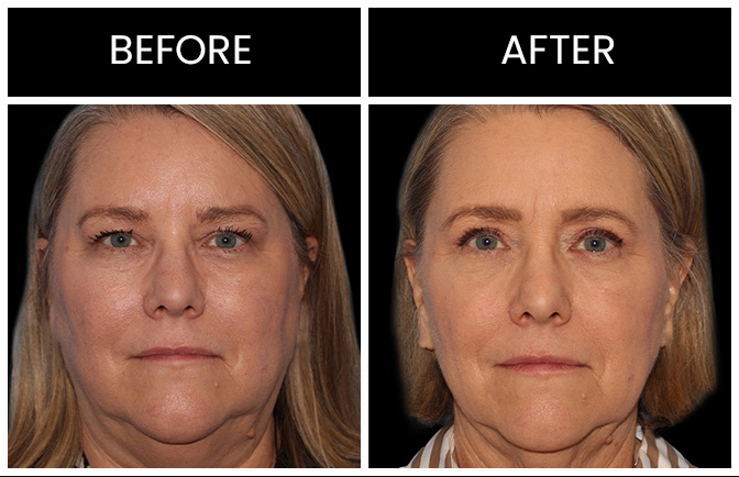 Atlanta Laser Skin Resurfacing Results