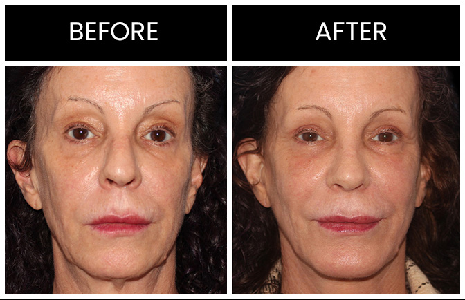 Laser Skin Resurfacing Results Atlanta