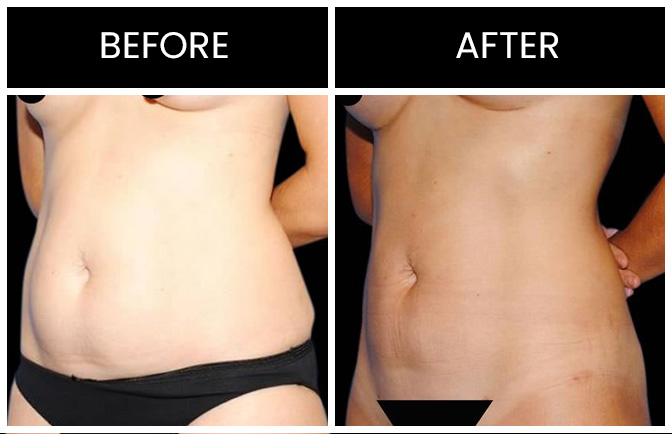 Liposuction Results Atlanta