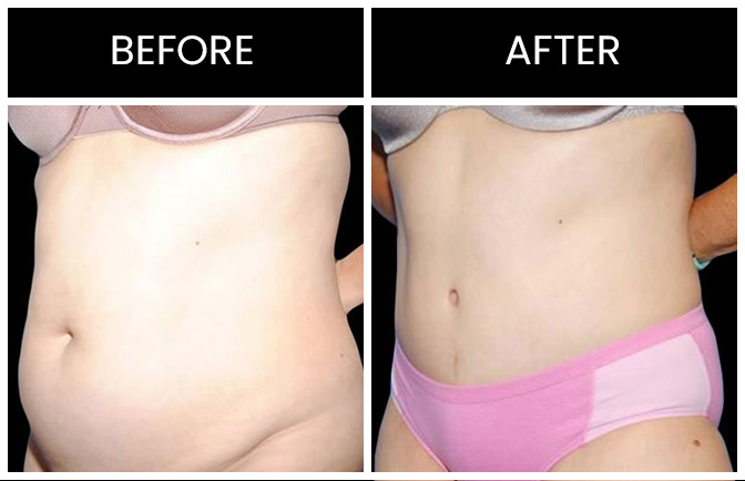 Atlanta Liposuction Results