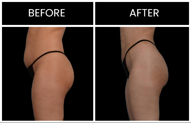 Liposuction Results Atlanta