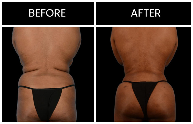 Atlanta Liposuction Results