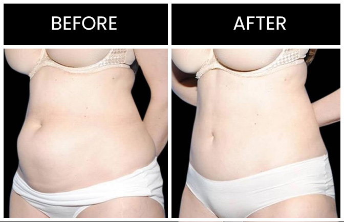 Atlanta Mini Tummy Tuck Results