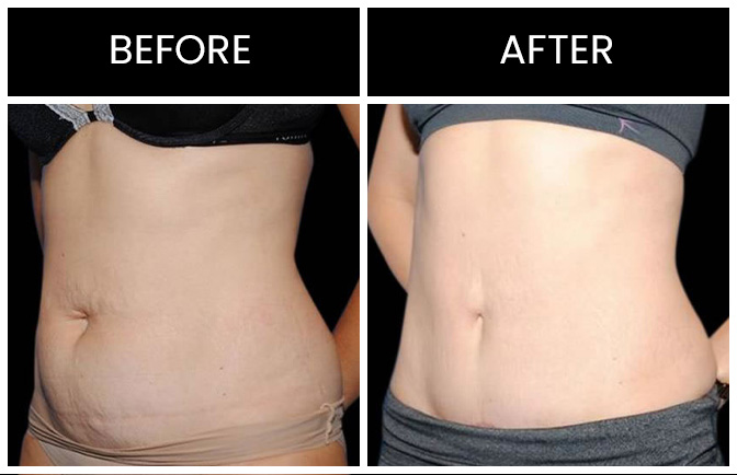 Mini Tummy Tuck Results Atlanta