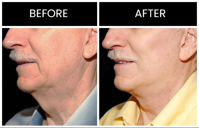 Atlanta Neck Lift Results