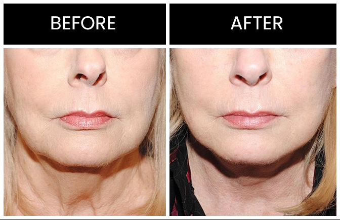 Neck Lift Results Atlanta