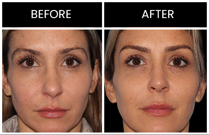 Revision Rhinoplasty Results Atlanta