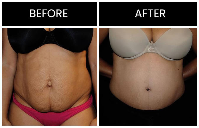 Tummy Tuck Results Atlanta