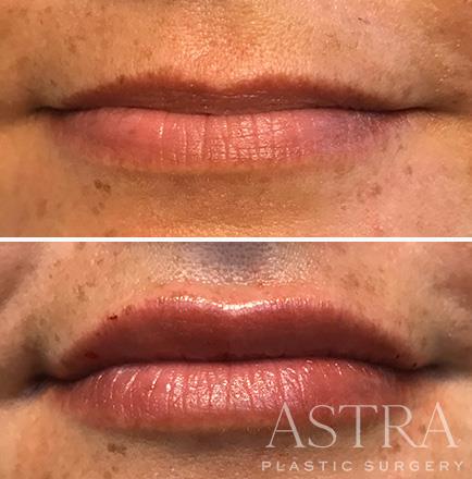 Before & After Cosmetic Fillers Atlanta GA