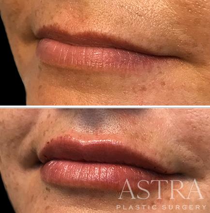 Before & After Cosmetic Fillers Atlanta GA ¾ View