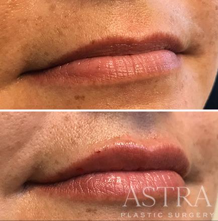 ¾ View Before & After Cosmetic Fillers Atlanta GA