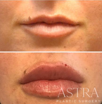 Close-Up Before & After Cosmetic Fillers Atlanta GA