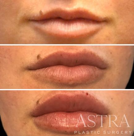 Before & After Cosmetic Fillers Atlanta Georgia