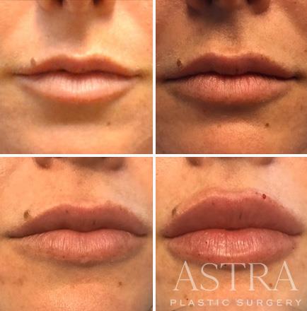 Atlanta Georgia Before & After Cosmetic Fillers