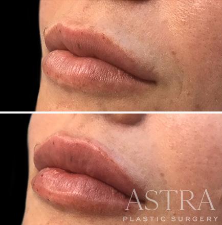 Atlanta Georgia Before & After Cosmetic Fillers Left