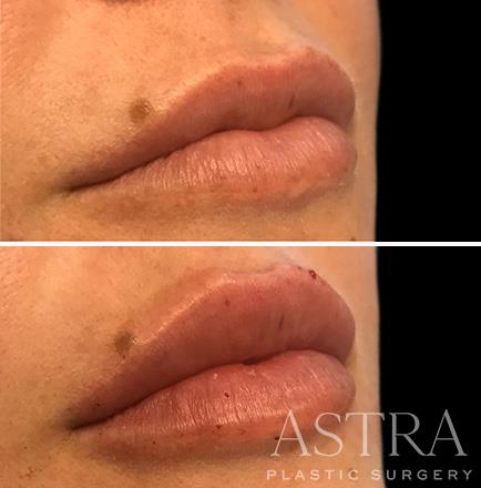 Before & After Cosmetic Fillers Atlanta Georgia Right