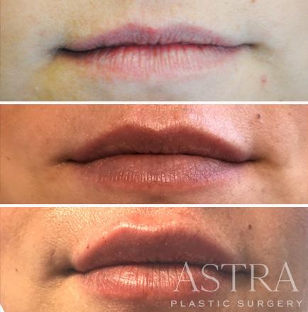 Before And After Cosmetic Fillers Atlanta Georgia