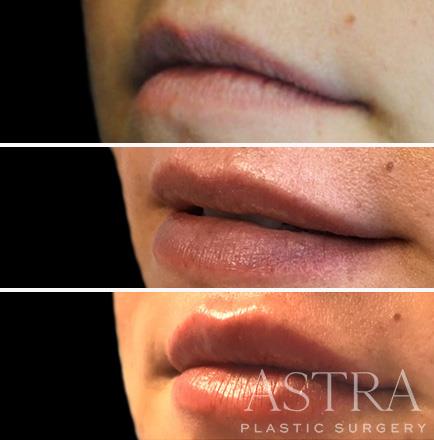 Before And After Cosmetic Fillers Atlanta Georgia ¾ View