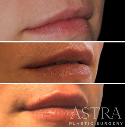 ¾ View Before And After Cosmetic Fillers Atlanta Georgia