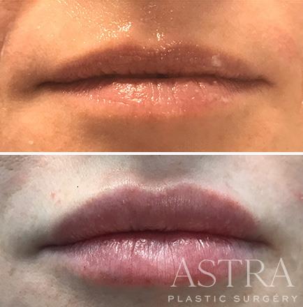 Before & After Dermal Fillers