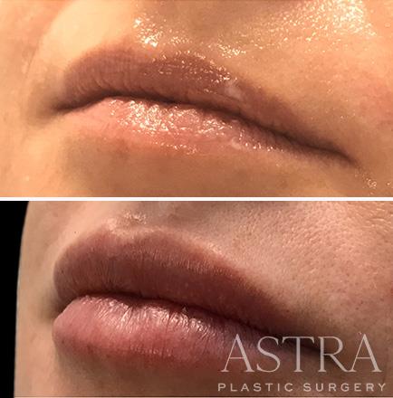 Dermal Fillers Before & After