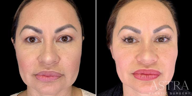 Atlanta Before & After Dermal Fillers