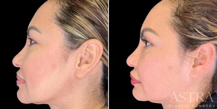 Before And After Dermal Fillers