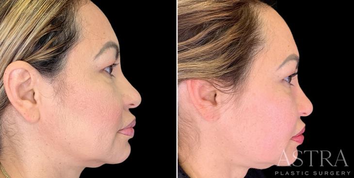 Atlanta Before And After Dermal Fillers